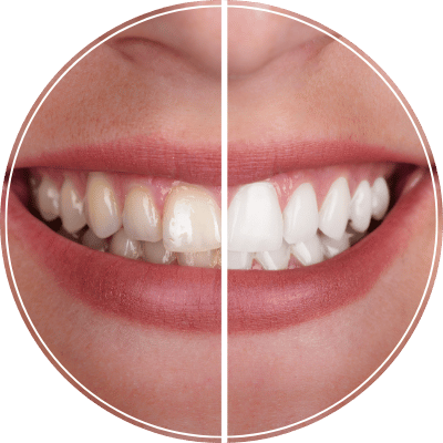 Clareamento dental - MDC Odontologia SP