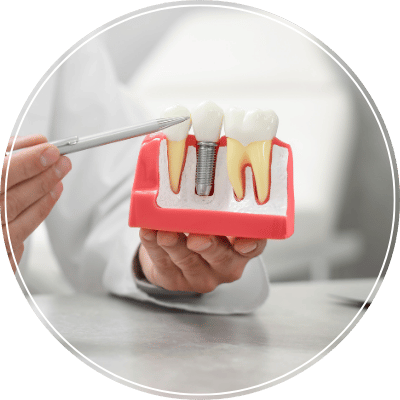 Implante Dentário_ - Clínica MDC Odontologia