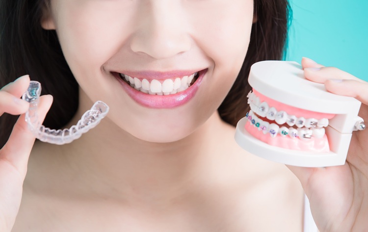 invisalign ou aparelho tradicional