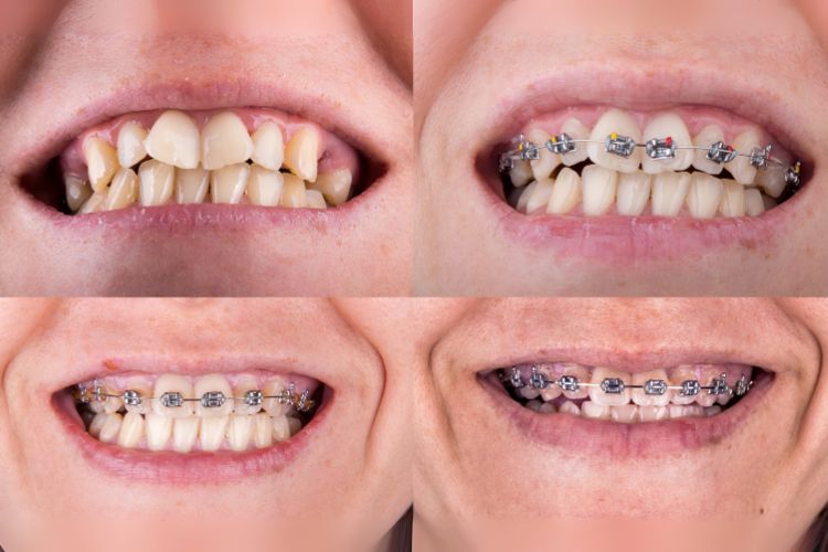 tipos de aparelho dental