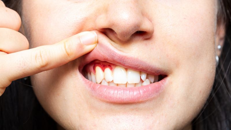 Mulher com gengiva inflamada, sinal de gengivite.